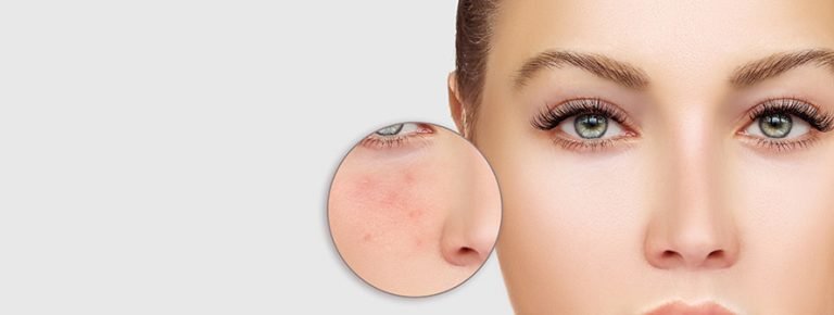 Can Be acne Patches Perform?